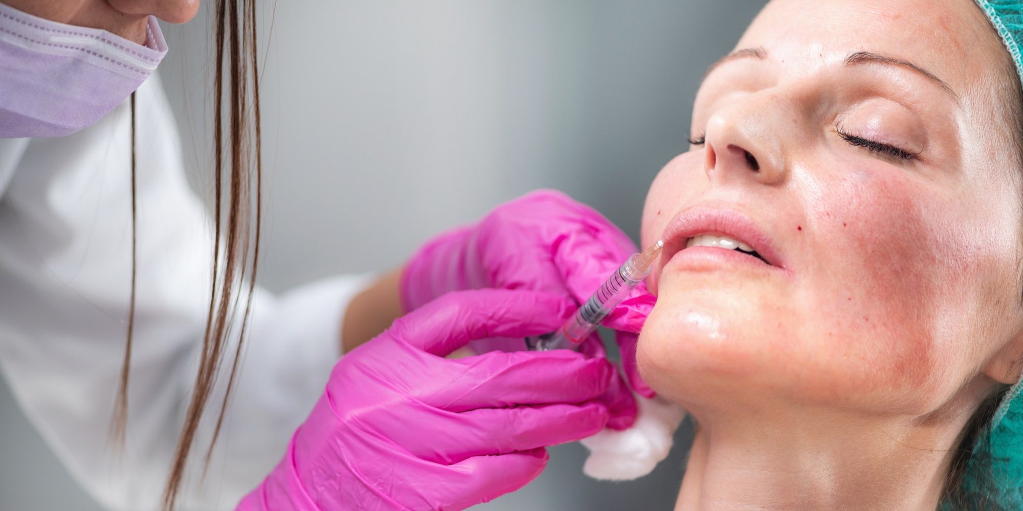 Dermal FillerTreatment at Vishka Skincare