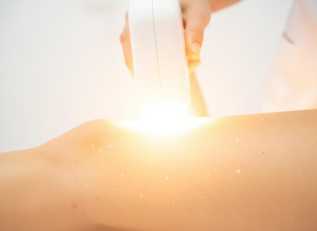 Laser Hair Removal for Sensitive Skin – Full Guide