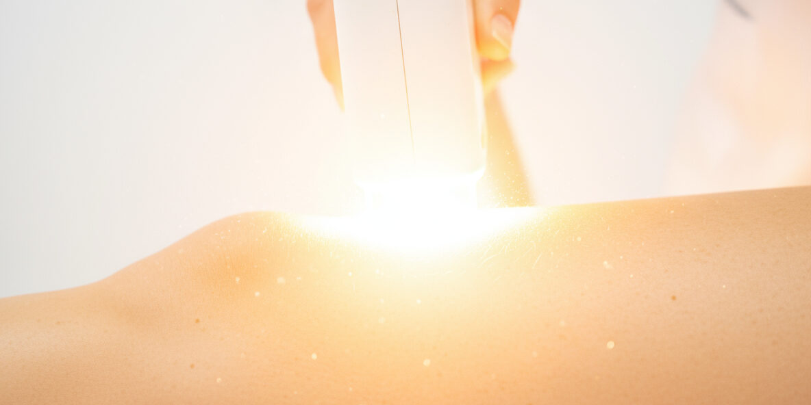 Laser Hair Removal for Sensitive Skin – Full Guide