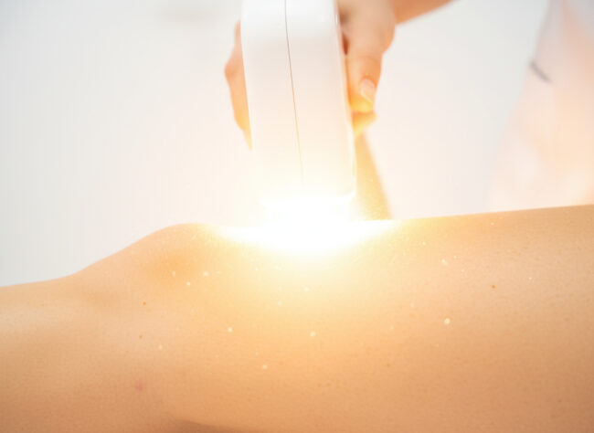 Laser Hair Removal for Sensitive Skin – Full Guide